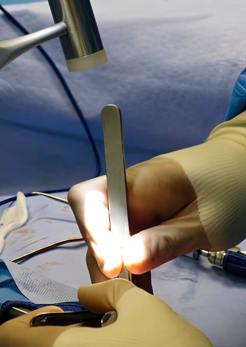 The nurse hits the osteotome with a hammer. The goal is to fracture and mobilize the nasal bones to treat either a crooked nose or wide bridge.