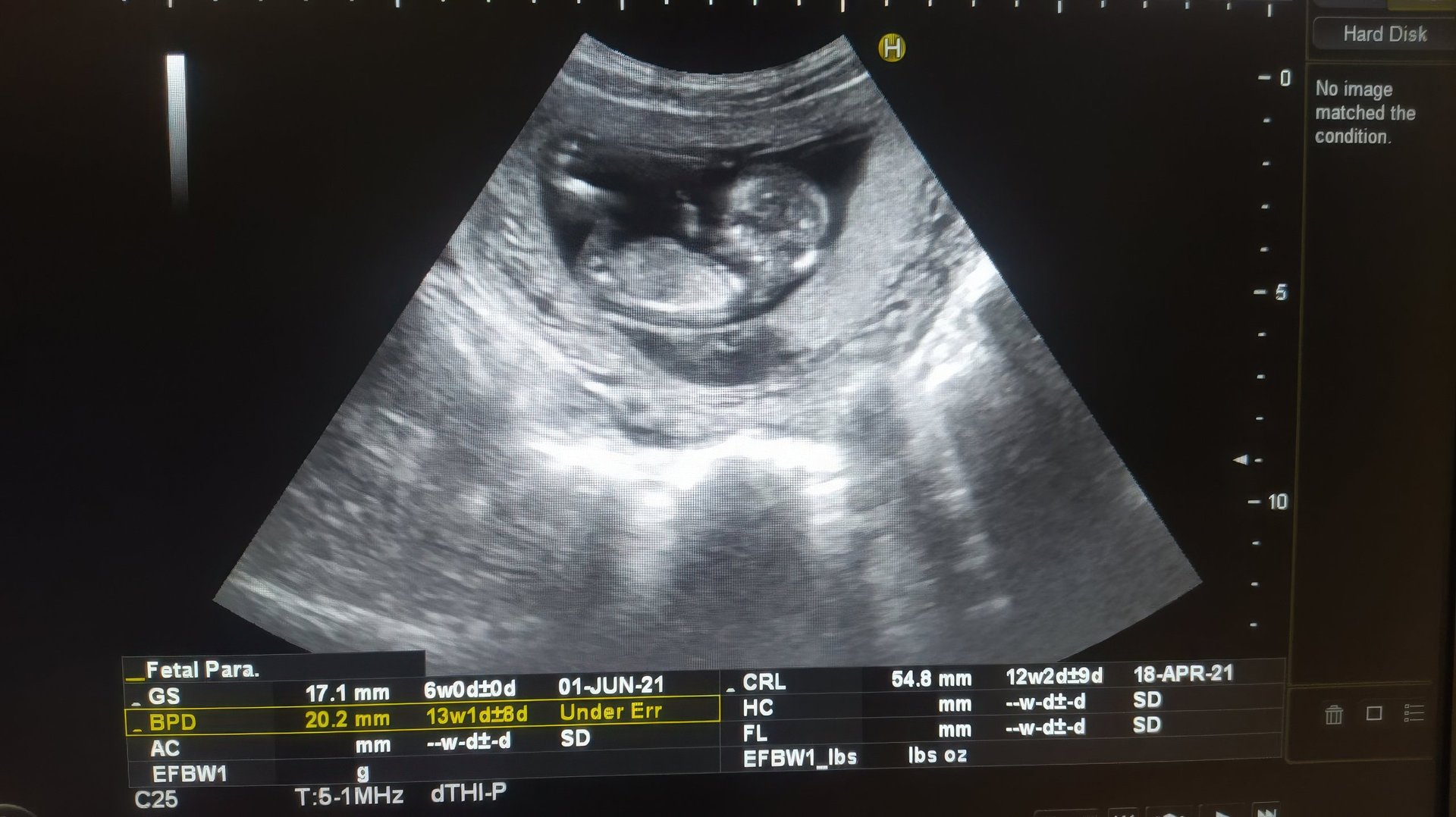Ultrasound scan displaying a developing fetus in its mother's womb showcasing diagnostic imaging technology