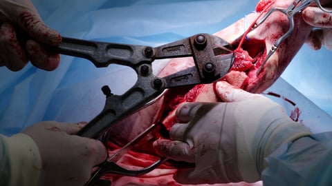 Surgeons performing complex surgical procedure with Metzenbaum scissors