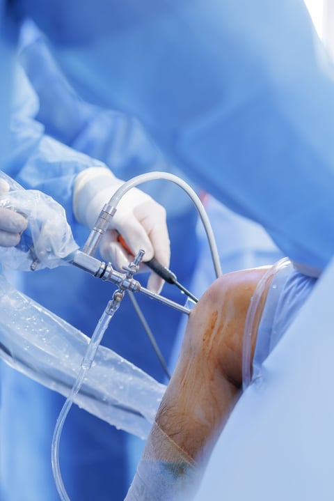 Close view of knee arthroscopy with PCL reconstruction showing arthroscope and cannulas on blue sterile drapes minimally invasive orthopedic surgery