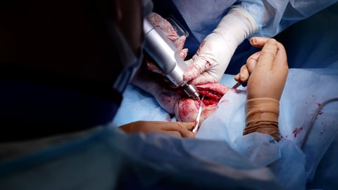 Medical professionals working with surgical drill during procedure