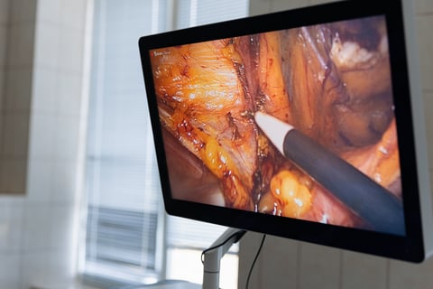 Professional medical monitor showing endoscopic surgery in progress. Surgeons using advanced laparoscopic instruments and digital visualization system for minimally invasive procedure in clinic.