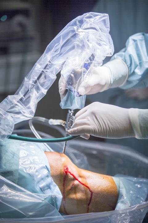 Traumatology orthopedic surgery hospital emergency operating room prepared for knee torn meniscus arthroscopy operation photo of drip fluids tube, arthroscope, arthroscopy camera and probe.