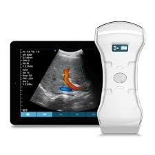 Portable ultrasound machine with handheld probe displaying cardiac imaging on monitor screen